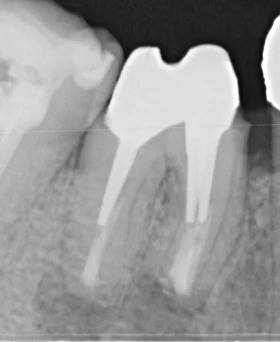 Chirurgie endodontique fin