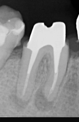Chirurgie endodontique initiale